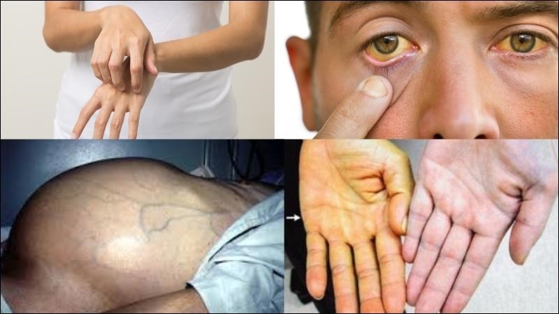 Người tăng men gan có thể có biểu hiện vàng da, mắt, ngứa hoặc bụng báng