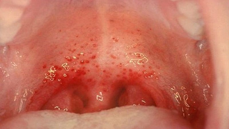 Viêm họng cấp là tình trạng viêm cấp tính ở vùng họng miệng