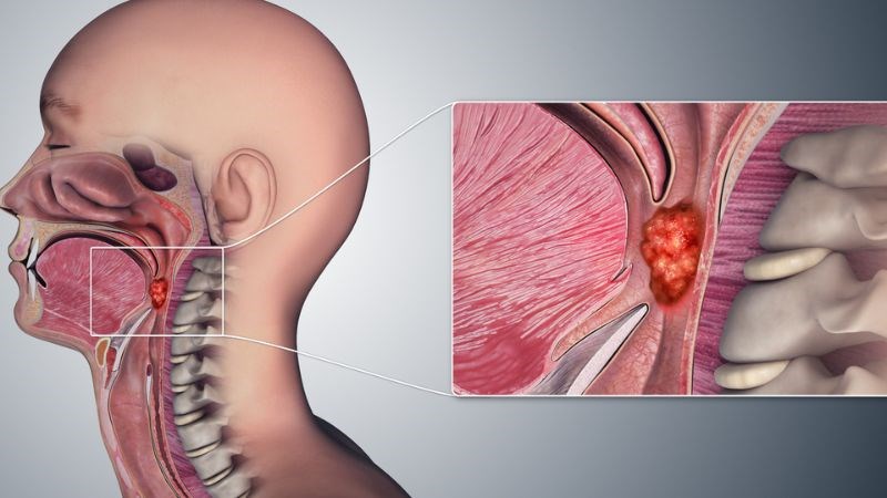Ung thư vòm hầu ngày càng trở nên phổ biến trong nhóm ung thư vùng đầu mặt Ung thư vòm hầu ngày càng trở nên phổ biến trong nhóm ung thư vùng đầu mặt