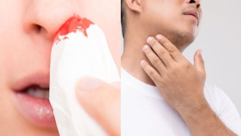 Chảy máu mũi và khối vùng hầu họng là triệu chứng điển hình của ung thư vòm họng Chảy máu mũi và khối vùng hầu họng là triệu chứng điển hình của ung thư vòm họng