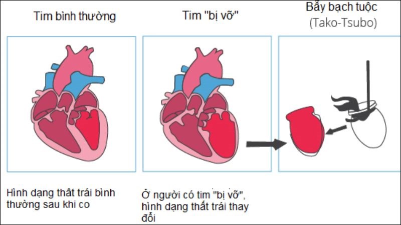 Bệnh Takotsubo là tình trạng thất trái tăng kích thước nhưng giảm chức năng đột ngột