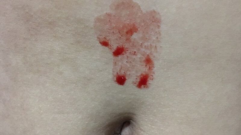 Chảy máu trên da bình thường không có vết thương