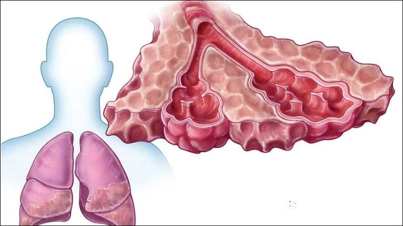 Xơ phổi vô căn là tình trạng phổi bị xơ nhưng chưa xác định được nguyên nhân