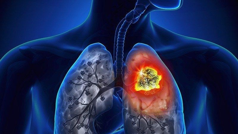 Ung thư phổi là một trong những biến chứng của xơ phổi