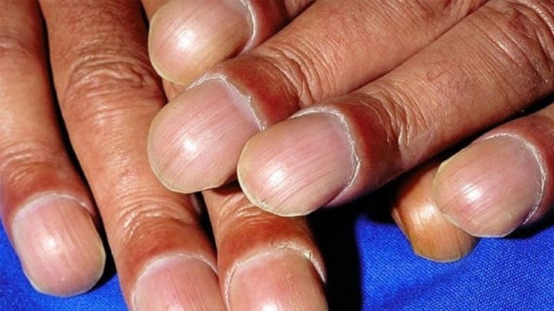 Khi xuất hiện tình trạng móng tay có khía nên đến các cơ sở y tế để được thăm khám và điều trị