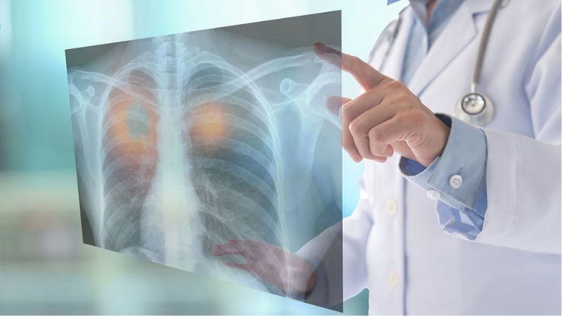 U phổi lành tính là khối u phổi tồn tại trong phổi nhưng không có tính chất ung thư U phổi lành tính là khối u phổi tồn tại trong phổi nhưng không có tính chất ung thư