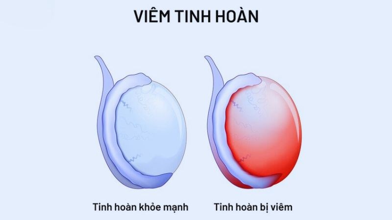 Tinh hoàn của bệnh nhân sưng lên gấp ba bốn lần so với bình thường