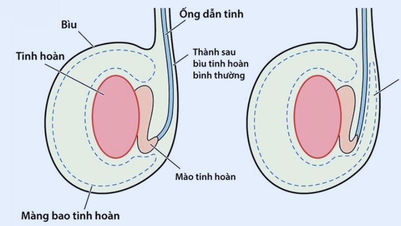 Vai trò của ống dẫn tinh là vận chuyển tinh trùng, giúp tinh binh gặp trứng để thụ thai