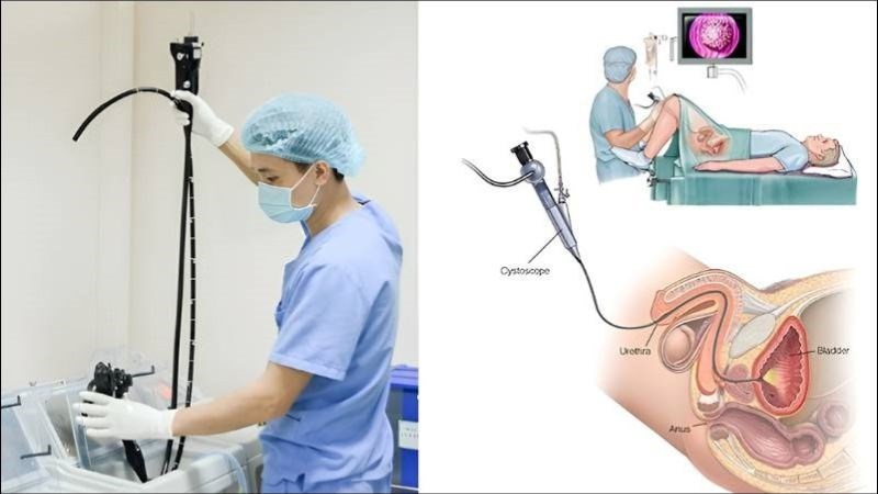 Cắt nội soi ống dẫn tinh qua niệu đạo là một phương pháp điều trị tắc ống dẫn tinh