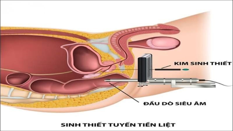 Sinh thiết tuyến tiền liệt giúp bác sĩ lựa chọn phương pháp điều trị phù hợp