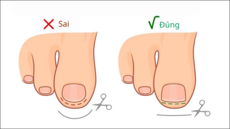 Cắt móng tay đúng cách để tránh móng bị mọc ngược