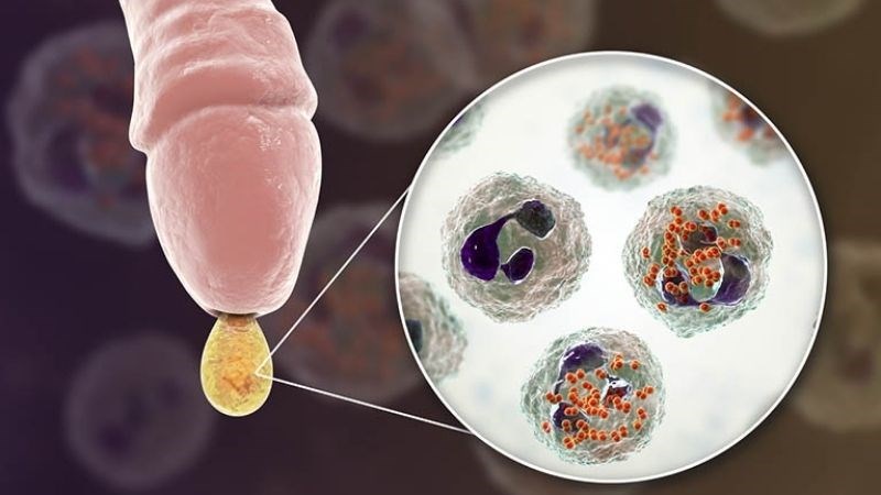Viêm nhiễm lâu ngày có thể gây tình trạng dài bao quy đầu