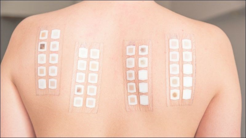 Kiểm tra dị ứng áp da là một phương pháp phổ biến nhằm chẩn đoán tình trạng dị ứng Kiểm tra dị ứng áp da là một phương pháp phổ biến nhằm chẩn đoán tình trạng dị ứng