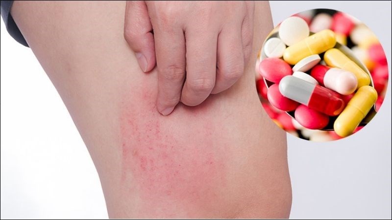 Phải ngừng thuốc ngay khi xuất hiện các triệu chứng dị ứng Phải ngừng thuốc ngay khi xuất hiện các triệu chứng dị ứng