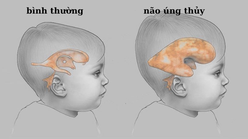 Não úng thủy có 4 loại