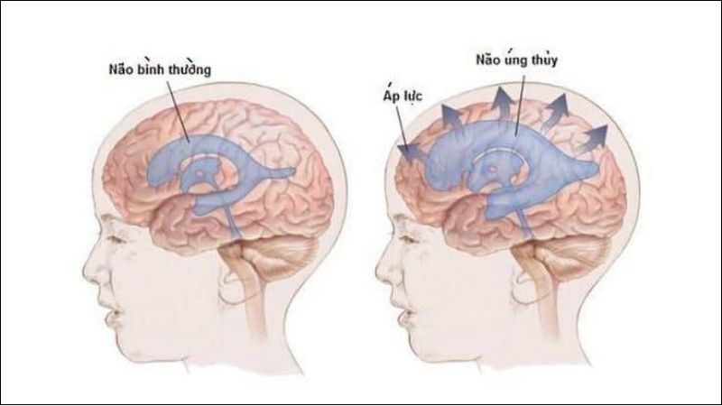 Sự tắc nghẽn là nguyên nhân phổ biến nhất của bệnh 