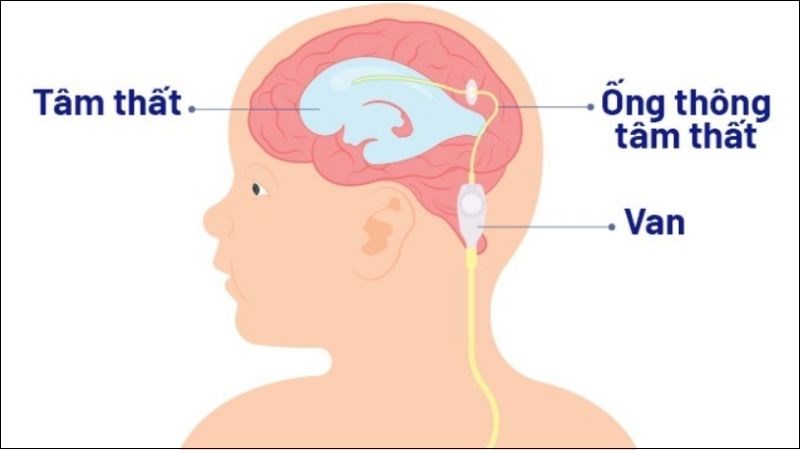 Phương pháp điều trị não úng thủy phổ biến nhất là phẫu thuật đặt shunt