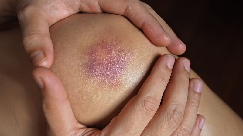 Các vết bầm rải rác khắp cơ thể do tự nhiên hoặc va chạm nhẹ là một trong các dấu hiệu cho thấy bạn cần gặp bác sĩ Các vết bầm rải rác khắp cơ thể do tự nhiên hoặc va chạm nhẹ là một trong các dấu hiệu cho thấy bạn cần gặp bác sĩ