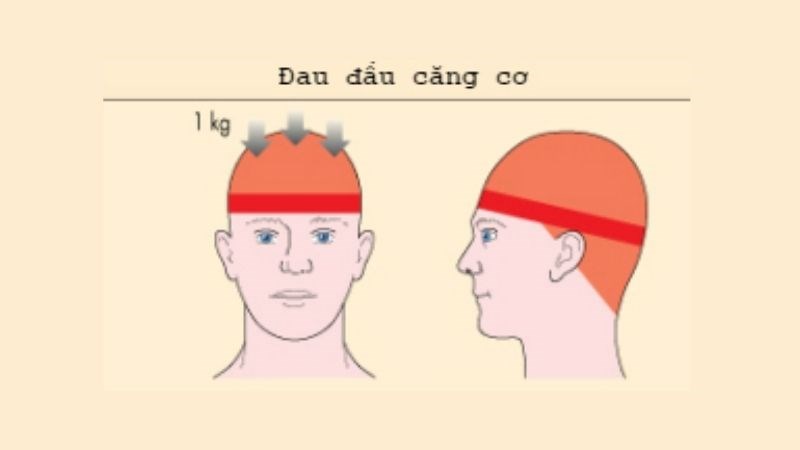 Đau đầu căng cơ: Nguyên nhân, triệu chứng và cách điều trị hiệu quả