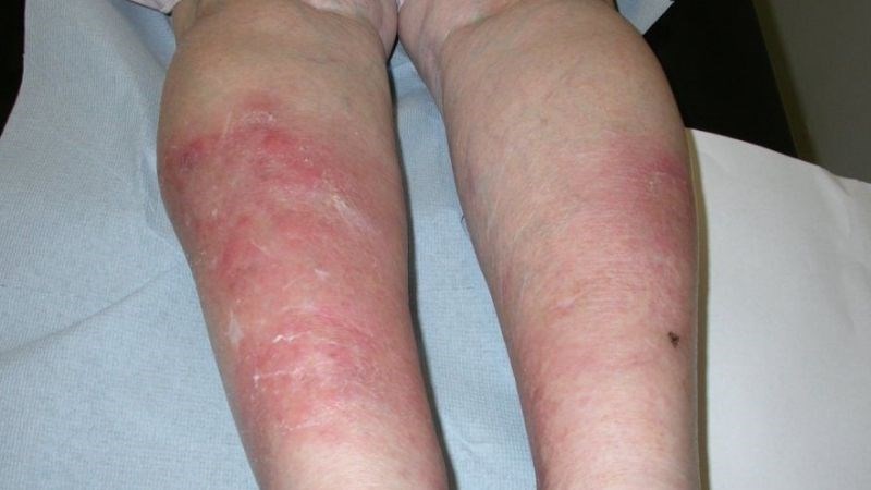 Viêm mô mỡ dưới da là tình trạng viêm ở các lớp dưới cùng của da.