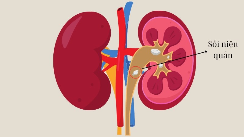 Sỏi niệu quản thực chất là sỏi hình thành ở thận đã di chuyển xuống niệu quản