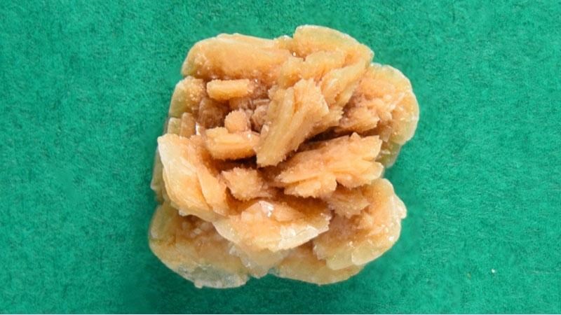 Sỏi canxi là loại sỏi niệu quản phổ biến nhất