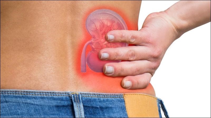 Sỏi niệu quản có thể gây ra cơn đau quặn vùng hông lưng