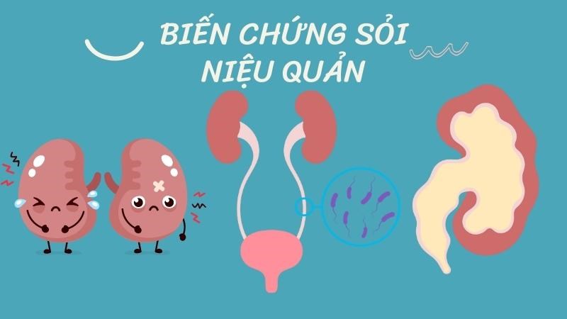 Sỏi niệu quản có gây biến chứng thận ứ nước, nhiễm trùng hệ tiết niệu và suy thận