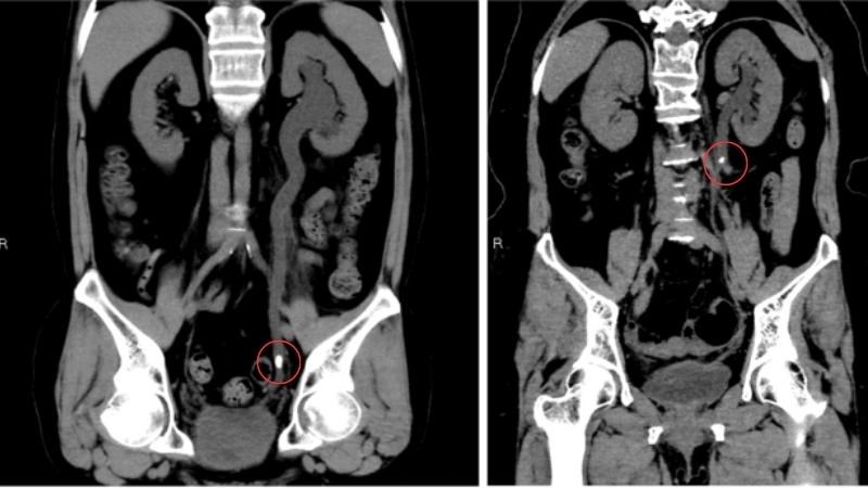 CT-scan được sử dụng để chẩn đoán sỏi niệu quản 