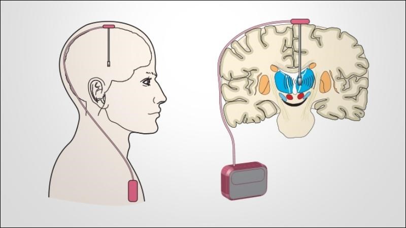 Kích thích não sâu là phương pháp có thể được sử dụng để điều trị OCD