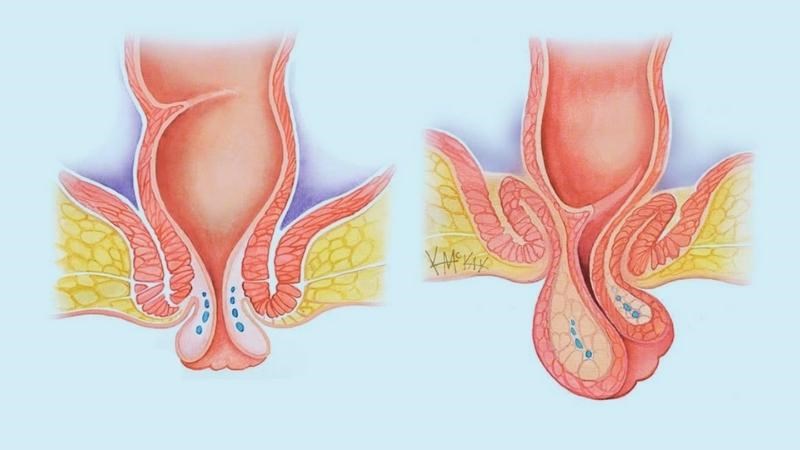 Táo bón lâu ngày có thể dẫn đến sa trực tràng