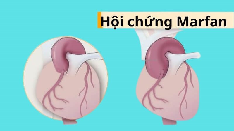 3. Chẩn Đoán Hội Chứng Marfan