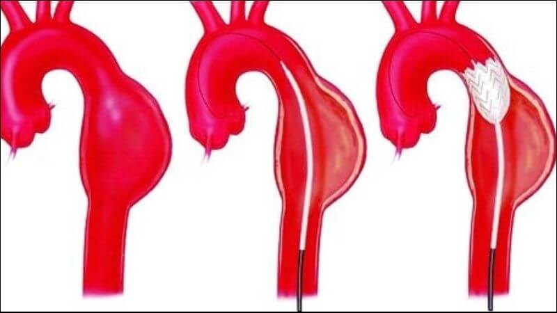 Phình động mạch là biến chứng của hội chứng Marfan