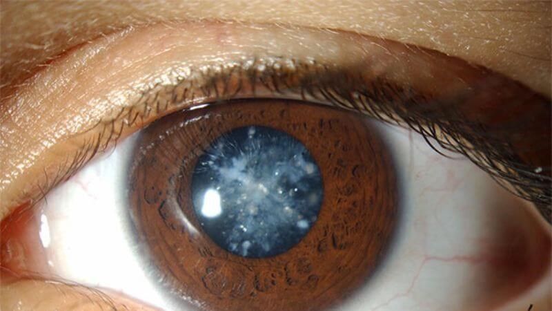 Đục thủy tinh thể sớm là một trong những biến chứng của hội chứng Marfan