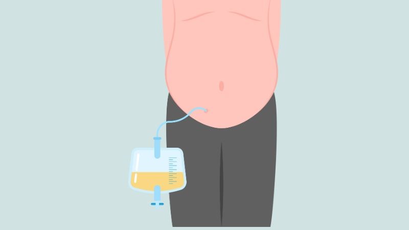 Bụng báng xuất hiện khi có quá nhiều dịch viêm tiết vào màng bụng