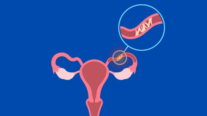 Biến chứng viêm tắc vòi trứng có thể dẫn đến tình trạng hiếm muộn