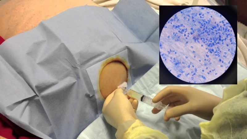 Dịch cổ trướng được lấy ra để xét nghiệm tìm vi khuẩn lao