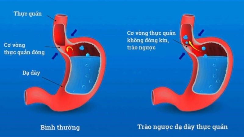 Trào ngược dạ dày thực quản là một nguyên nhân gây loét thực quản