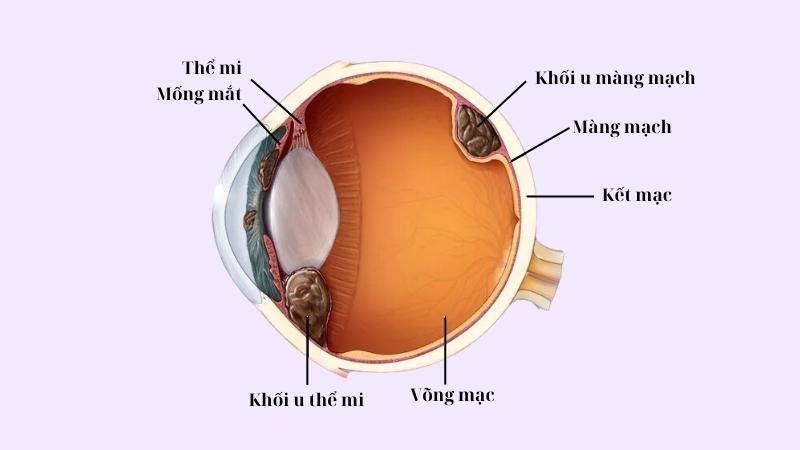 Ung thư nội nhãn có thể phát triển từ mống mắt, thể mi hoặc màng mạch Ung thư nội nhãn có thể phát triển từ mống mắt, thể mi hoặc màng mạch