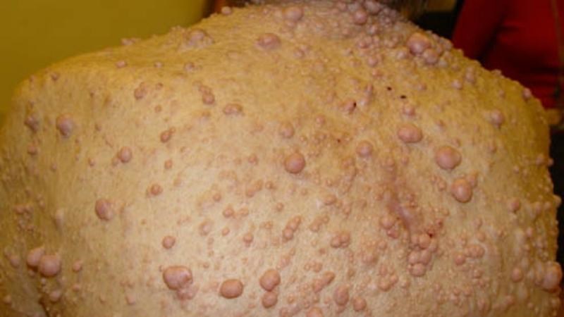 NF1 có biển hiện là khối u mềm trên hoặc dưới da cỡ hạt đậu NF1 có biển hiện là khối u mềm trên hoặc dưới da cỡ hạt đậu