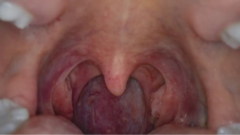 Khám họng trong ung thư amidan nhằm phát hiện các khối u bất thường ở họng