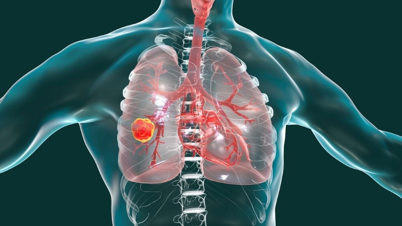 Ung thư amidan giai đoạn IV có thể di căn đến phổi