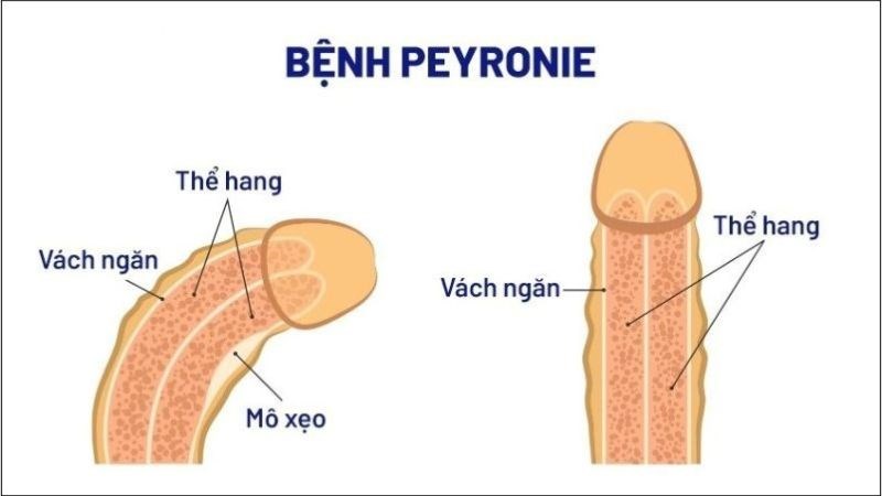 Bệnh Peyronie là nguyên nhân gây mô sẹo bên trong dương vật Bệnh Peyronie là nguyên nhân gây mô sẹo bên trong dương vật