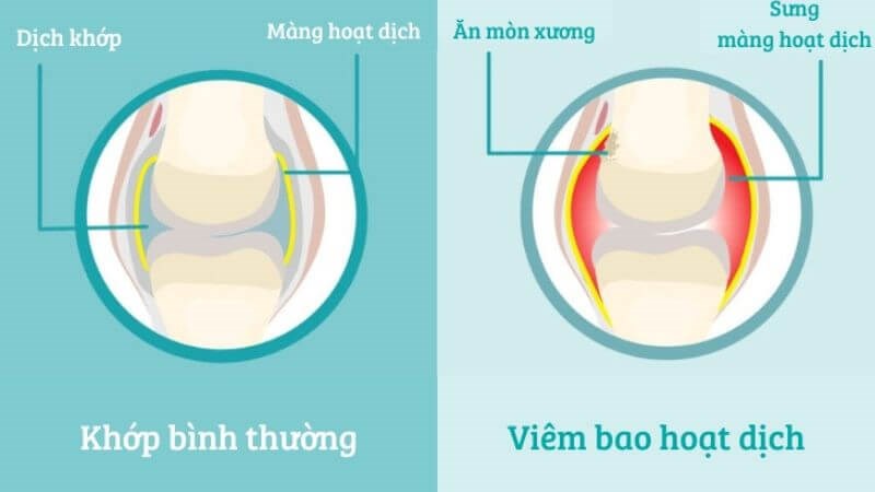 Viêm bao hoạt dịch là tình trạng chất lỏng trong bao hoạt dịch bị viêm
