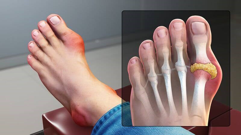 Bệnh gout có thể tăng nguy cơ mắc viêm bao hoạt dịch