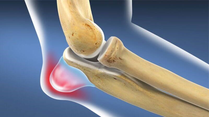 Viêm bao hoạt dịch có thể xuất hiện hạn chế vận động