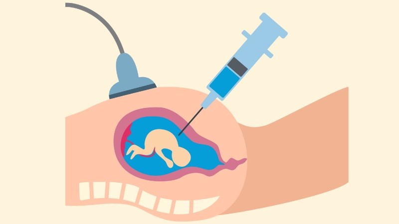 Kỹ thuật chọc nước ối giúp xét nghiệm những bất thường nhiễm sắc thể của thai