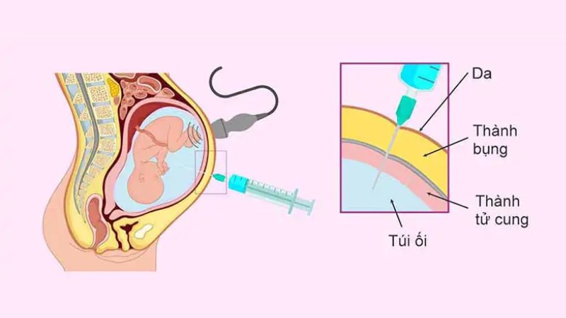 Hút bớt nước ối dư thừa giúp giảm áp lực cho mẹ và thai nhi