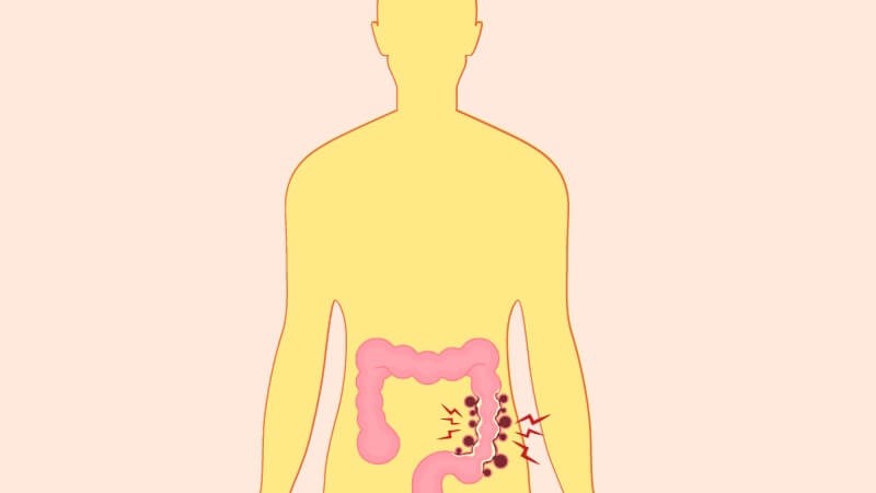 Viêm túi thừa là tình trạng túi thừa đại tràng bị viêm cấp tính hoặc mạn tính Viêm túi thừa là tình trạng túi thừa đại tràng bị viêm cấp tính hoặc mạn tính