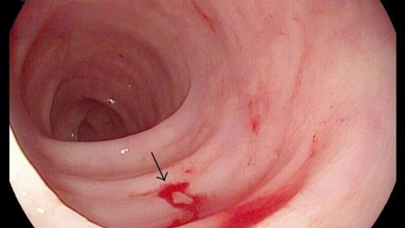 Viêm túi thừa tiến triển xấu có thể hình thành lỗ rò trên thành đại tràng Viêm túi thừa tiến triển xấu có thể hình thành lỗ rò trên thành đại tràng